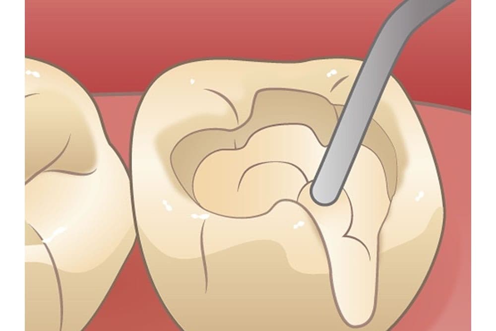 虫歯治療・精密根管治療