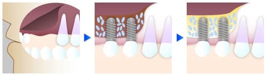 インプラント（口腔外科）
