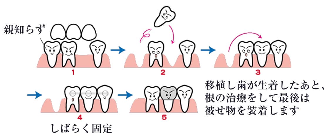 親知らずの抜歯・移植（歯科口腔外科）